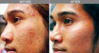 Chicago Laser Skin Rejuvenation